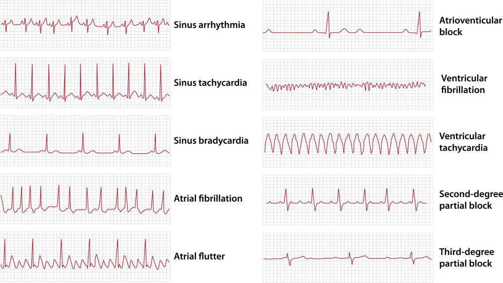 EKG Rhythmus Beispiele